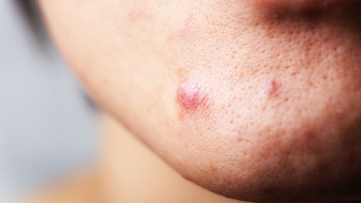 “Je pensais que c’était un petit bouton d’acné” mais c’était une infection sous-cutanée qui a nécessité “une incision en urgence sous anesthésie locale”