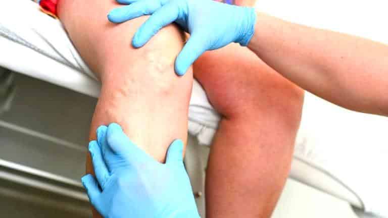 “C’était une observation médicale” raconte un patient avant le diagnostic de thrombose veineuse profonde