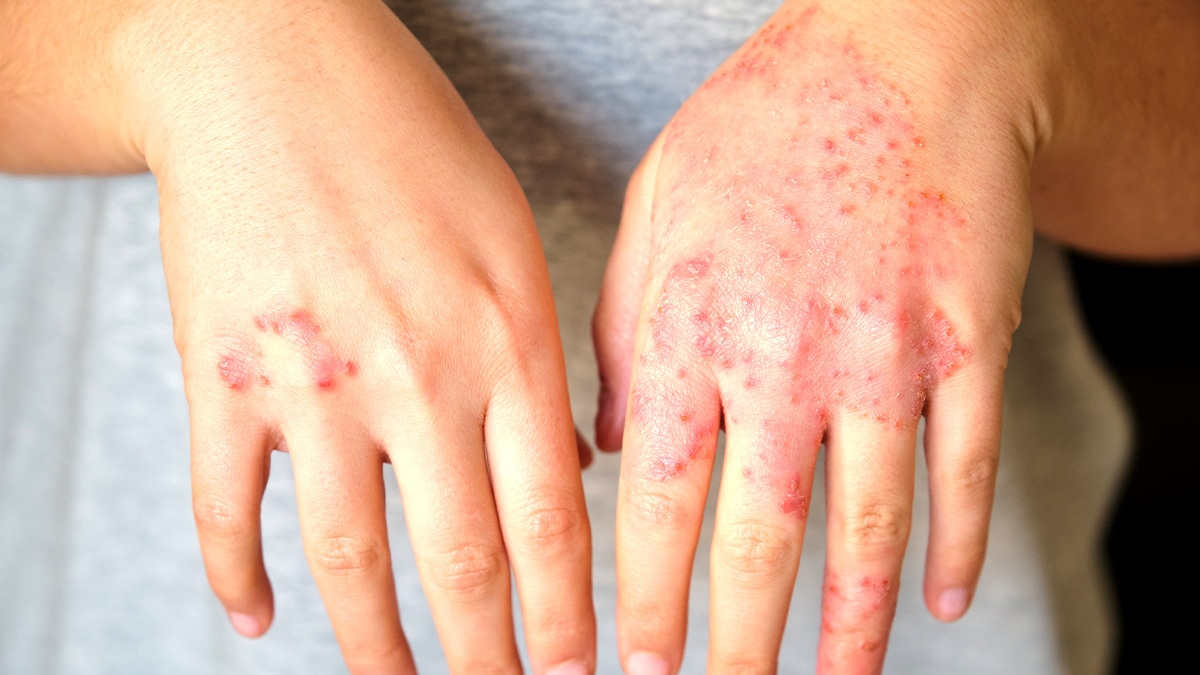 “C’était juste un test à domicile” accuse une patiente avant la détection d’une allergie sévère au latex