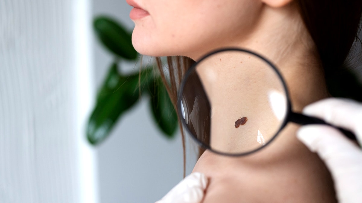 “C’était une simple consultation en ligne” raconte un patient avant la découverte d’un mélanome